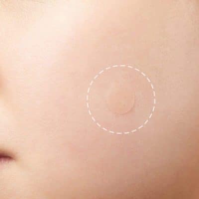 Skin Tag and Acne Patches