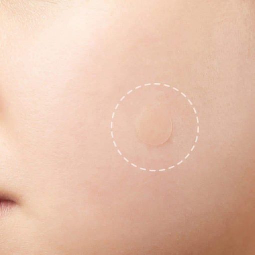 Skin Tag and Acne Patches