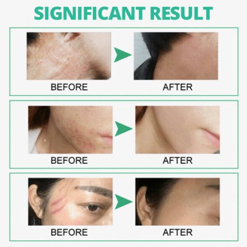 Skin Rebound Scarless Cream - Image 6