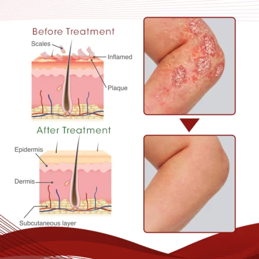 DermaCure Psoriasis Treatment Spray - Image 3